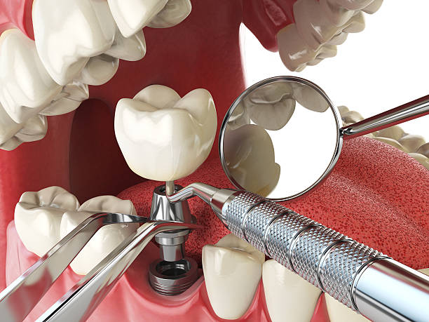 Best Chipped Tooth Repair Near Me  in Conway, SC